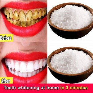 Teeth whitening at home in 3 minutes | Post Beauty Tips