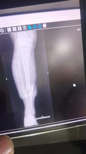 open wound fracture of fibia and tabia.