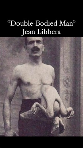 History Everyday on Instagram: "In the early 20th century, Jean Libbera, also referred to as the “Double-Bodied Man,” was a sideshow performer alongside his parasitic twin, Jacques. Jacques was attached to Jean’s chest and abdomen, featuring two underdeveloped arms, legs, and a partially developed head integrated into Jean’s body. Relying completely on Jean for circulatory and nervous system support, Jacques was an integral part of Jean’s life. Remarkably, Jean led a relatively typical life, hav