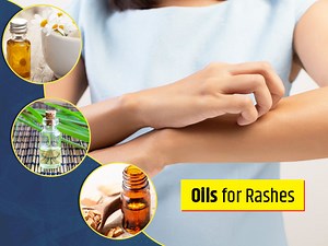 Soothe Summer Skin Rashes With These Essential Oils for Rashes