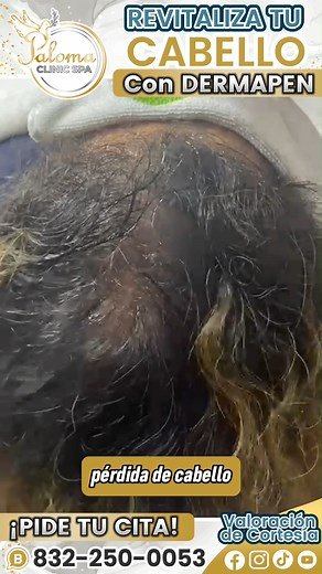 Dermapen Capilar: tratamiento para la caída del cabello💚para Hombres. y Mujeres. Vive para ti, quiérete! En 🕊 Paloma Clinic Spa 🕊 te contamos sobre los beneficios que tu cabello obtiene por el tratamiento Dermapen✨ 🌿Fortalece tu cuero cabelludo 🌿Tecnología para mejorar tu cabello: más efectivo y más rápido 🌿Permite que bajo el cuero cabelludo penetren los principios activos según tu necesidad 🌿Mejora la densidad capilar y logra una mejor calidad del cabello Ven y vive la experiencia✨Valor