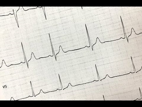 【CVICでできる検査】ホルター心電図