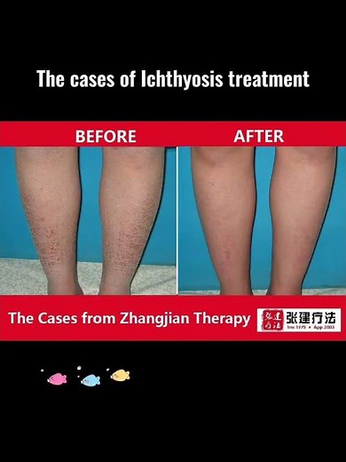 The cases of ichthyosis treatment #ichthyosistreatment #ichthyosisvulgaris