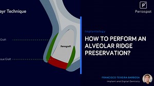 How to Perform an Alveolar Ridge Preservation