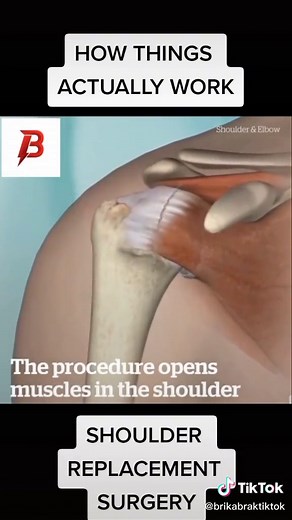 HOW THINGS ACTUALLY WORK ( SHOULDER REPLACEMENT SURGERY ) #operation #fyp #howthingswork #surgery #howthingsactuallywork #foryoupage #shoulders #replacement