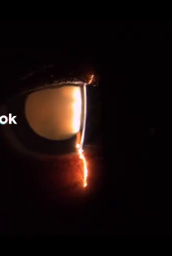 Understanding Cataracts: Causes, Symptoms, and Treatments