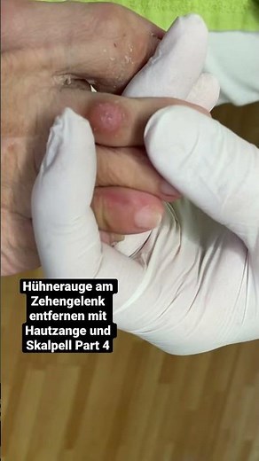 Remove corns from the toe joint with skin forceps and a scalpel Part 4, podologinandrea