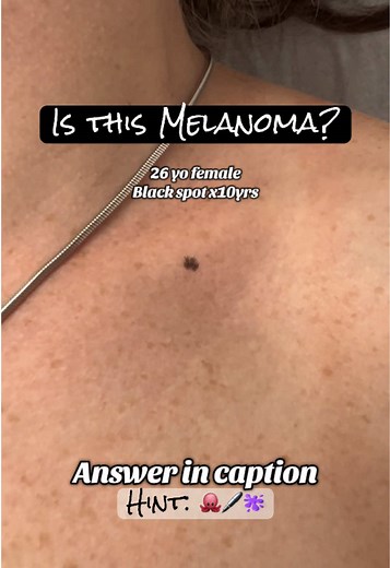 Skin cancer… or not? 🤔 #tricky Hint: 🐙(Ink) 🖋️(spot) 🫟(lentigo). —Don’t judge a spot by its shade. Despite its “ugly duckling” look, ink spot lentigo is a benign lesion, without true melanoma-specific structures under dermoscopy. 🎯The key is to not be fooled by the dark color alone — look for symmetry, homogeneity, and context (sun exposure, stability). Of course, it’s not easy to tell, so if you have a spot like this, best to consult a dermatologist ❣️ #melanomaawareness #melanoma