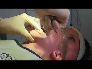 4 Year Old Tooth Extraction
