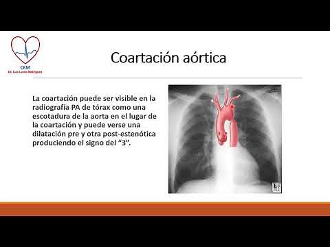 Aortic coarctation radiological findings