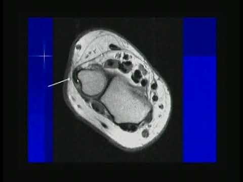 MRI of the Wrist