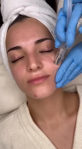 American Girl Cheek + Chin Pimple Vacuum Doctor ASMR ✨