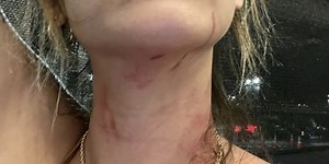 ‘I felt lifeless’: Woman brutally beaten in Kihei asks for help in finding attackers