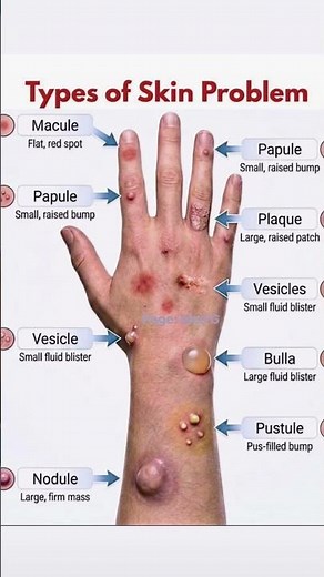 Types of Skin Problems Explained | Macule, Papule, Vesicle, Bulla & More