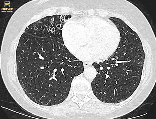 Lady Windermere Syndrome - Radiology features and differtial diagnosis
