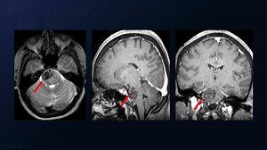#146: Extended Retrosigmoid Craniotomy and Trans-Cerebellopontine Angle Approach for Resection of a Peritrigeminal Cavernous Malformation - All Videos - Seven Series Collection