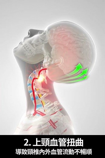 Medex Brace hk 頭暈頭痛眼花：不一定是頭暈頭痛問題