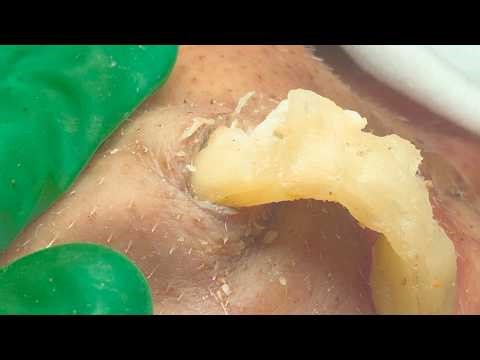 𝑺𝒌𝒊𝒏𝒄𝒂𝒓𝒆 𝑺𝒐𝒐𝒕𝒉𝒊𝒏𝒈 𝑬𝒙𝒕𝒓𝒆𝒎𝒆 𝑨𝒄𝒏𝒆 𝑷𝒐𝒑𝒑𝒊𝒏𝒈 𝑭𝒐𝒓 𝑺𝒕𝒓𝒆𝒔𝒔 𝑹𝒆𝒍𝒊𝒆𝒇 𝑺𝒂𝒕𝒊𝒔𝒇𝒚𝒊𝒏𝒈 𝑹𝒆𝒍𝒂𝒙𝒊𝒏𝒈 #6273