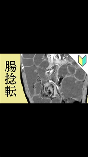 腸捻転について解説します。youtubeでさらに詳しく解説しているので、よかったらリンクからおきらく放射線チャンネルをご覧ください。 #画像診断 #腹部ct #放射線画像 #ct画像 #腸閉塞 #イレウス 大腸 #小腸イレウス #小腸 #腸捻転