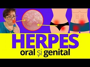 Herpes ORAL si GENITAL: cauze + Remedii acasa