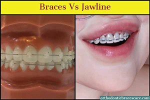 Can Braces Change Your Jawline? How? - Orthodontic Braces Care