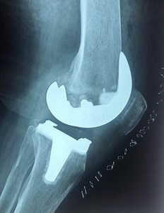 116K views · 399 reactions | KNEE REPLACEMENT SURGERY BY DR ZEESHAN KHAN (FRCS Ortho U.K.) We use the non muscle cutting surgical technique during our knee replacement surgery and enhanced recovery techniques which helps in early mobilisation and early return to function. Here is the function of one of such patient at 2nd day following knee replacement surgery. For more information please contact our PA Mr Naeem on 03469228490. | ZK Orthopaedics | Facebook