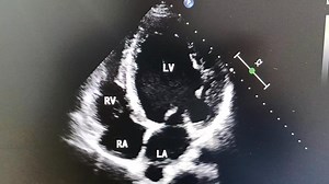 248K views · 1.7K reactions |  Classic Echo Finding: Apical Rocking...
