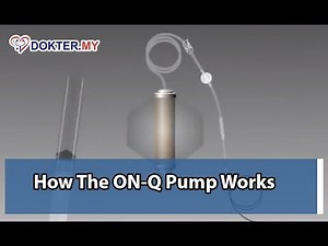 How the ON-Q Pump Works