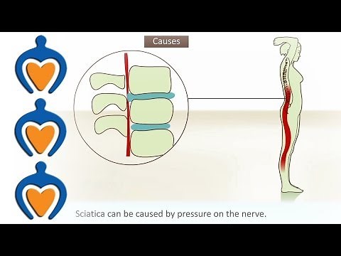 Sciatica - What is it and how is it treated?