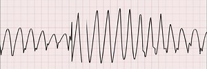 Identify the following rhythm (see 6-second rhythm strip): | Nursing and NCLEX Mastery