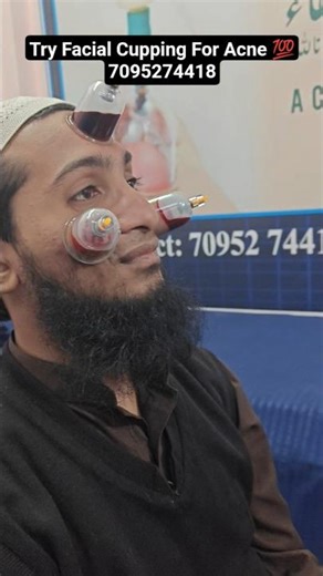 Try Facial Cupping For Acne 💯 #cupping #hijama#acne#pimples#naturaltherapy#treatment#skincare#reels