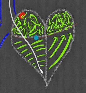 Single Chamber Pacemaker Atrial Fibrillation