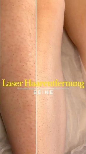 ★ Laser-Haarentfernung: Beine Vorher & Nachher | 1 ★ Laser Hair Removal: Legs Before & After | 1 ★