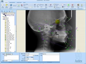 Using software to make cephalometric analyses