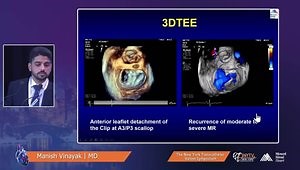 Successful Bail-Out Edge to Edge Repair for an Acute Single Leaflet Device Attachment (SLDA)