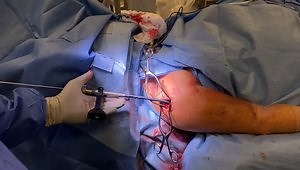 Humerus Fracture Repair - Intramedullary Rodding