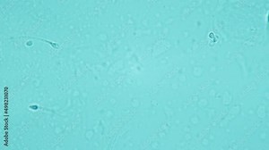 In vitro fertilisation. IVF. Selection of genetic material for the fertilization of the egg. Human spermatozoa under a microscope. 1000X magnification. Programming characteristics of future offspring