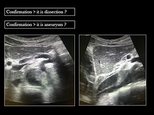 Abdominal Ultrasound - Aortic dissection