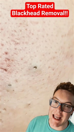 Top Rated BLACKHEAD REMOVAL 2026 #shorts