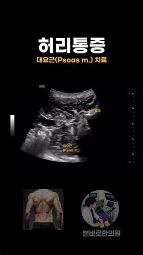 허리통증(대요근) 치료