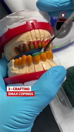 IPS e.max Press® Veneers | Upper & Lower Arch Smile Design #dentist #dentistry #dentalclinic