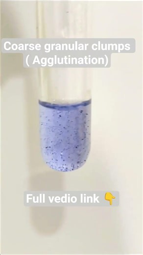 Granular Clumps = POSITIVE ✅ | Widal Test Agglutination Explained