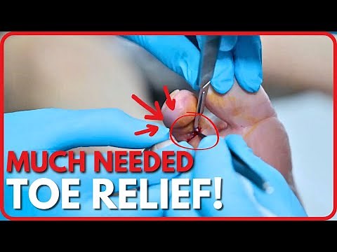 Saving a Toe: Specialized Procedure for a Non-Healing Wound 👣