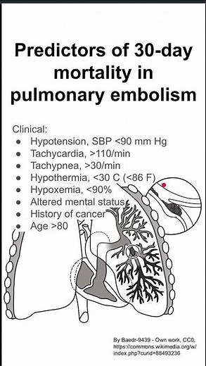 Predictors of 30-day mortality in pulmonary embolism