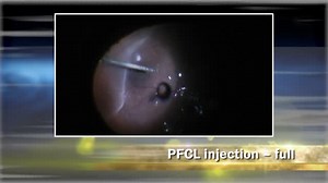 Pars Plana Vitrectomy for Rhegmatogenous Retinal Detachment: From A to Z - Eyetube