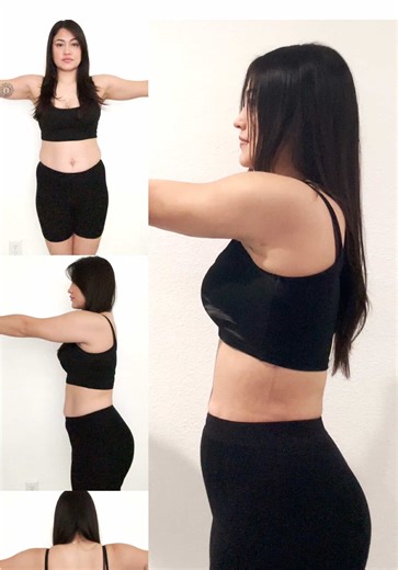 One month after her Beverly Hills procedure, Desiree’s Stomach Airsculpt and fat transfer to hips results are already taking shape. And this is just the beginning—final results at six months! #airsculpt #skintightening #fatremoval #lipo