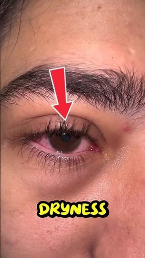 👀 Why Do Eyes Burn Again and Again? 😮📱