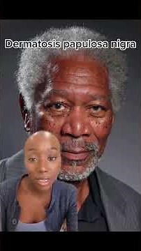 Brown Spots on the Face