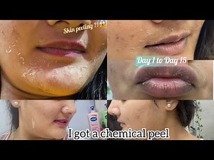 I got a chemical peel treatment for acne scars & pigmentation || Skin Peeling || Experience