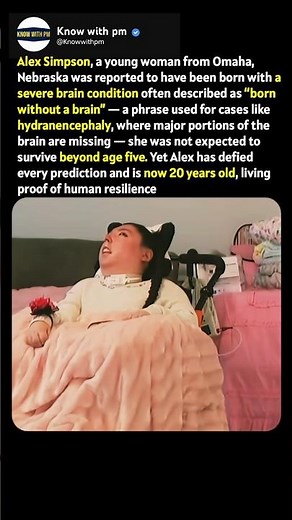 This girl born without a brain 😨